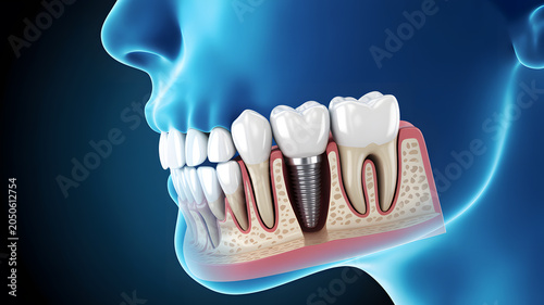 A detailed illustration of a dental implant in a human mouth with glowing blue effects