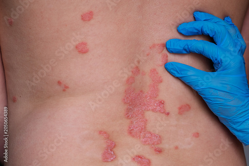 Photos Close-up view of psoriasis lesions on the back of a person, with a gloved hand g