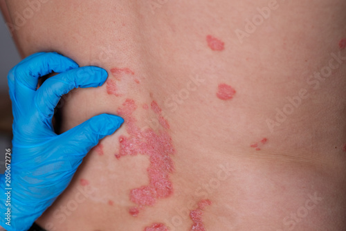 Photos Close-up view of psoriasis lesions on a person's back, with a gloved hand gently
