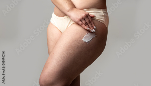 Fotografía Cellulite on legs with fat and skin dimples