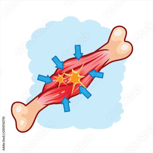 Fotografie Reflex Muscle Contraction Response to Pain Illustration
