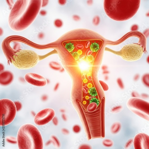 Illustration of a uterus with blood cells and bacteria, highlighting infection.