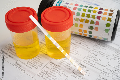 Bild auf Leinwand Urinalysis, urine cup with reagent strip pH paper test and comparison chart in laboratory