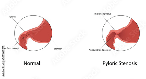 Fotografía Pyloric stenosis vector illustration
