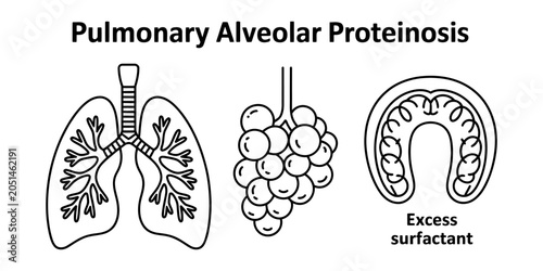 Canvastavla Medical illustration showing pulmonary alveolar proteinosis with human lungs and