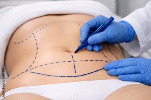 Plastic surgery marking on abdomen before medical procedure.. Ai generative