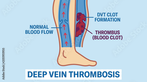 Bild auf Leinwand Deep Vein Thrombosis Blood Clot Formation In Lower Extremity