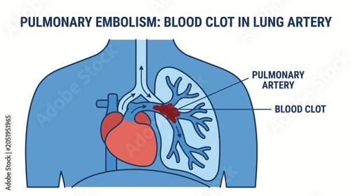 Foto Pulmonary Embolism Blood Clot Lodged In Lung Artery Diagram