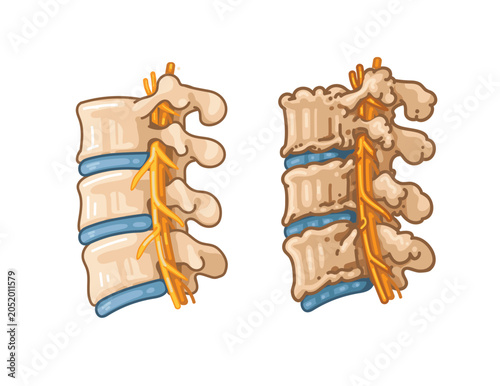 Foto Cervical spine degeneration infographic