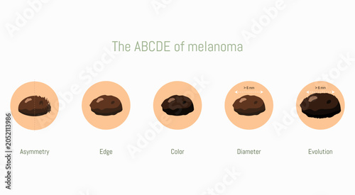 ABCDE rule for melanoma detection showing warning signs of skin cancer