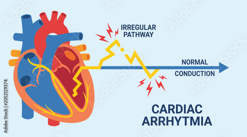 Photos Cardiac Arrhythmia Irregular Heartbeat Electrical Conduction Pathway
