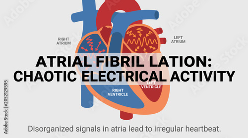 Konstfotografi Atrial Fibrillation Chaotic Electrical Activity In Heart Chambers