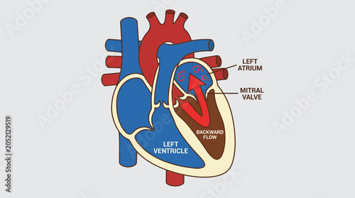 фотографія Mitral Valve Regurgitation Backward Blood Flow Leakage Illustration