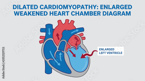 Foto Dilated Cardiomyopathy Enlarged Weakened Heart Chamber Diagram