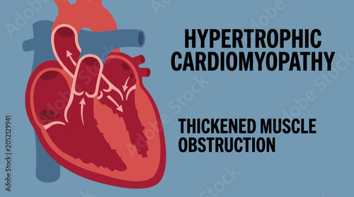 Cuadro en lienzo Hypertrophic Cardiomyopathy Thickened Muscle Obstruction Illustration