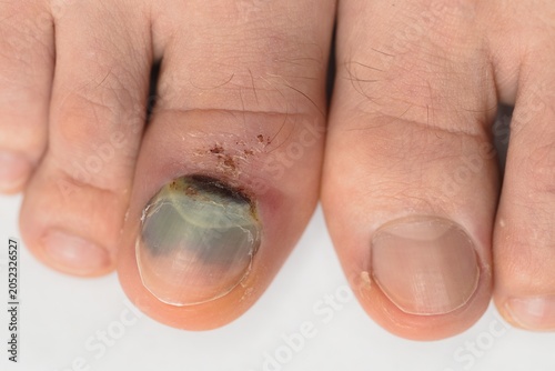 A close-up photograph of a human foot with a severe toenail infection. The toenail of the big toe is thickened, discolored, and partially detached because of a broken bone
