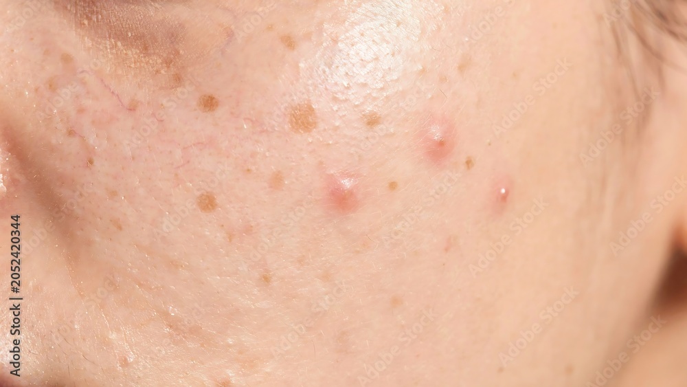 Fototapeta premium Close up of acne on a person's cheek skin with freckles and blemishes on face
