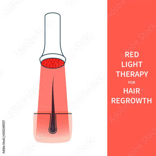 Red light therapy hair regrowth device for skincare and alopecia treatment. Medical vector illustration.