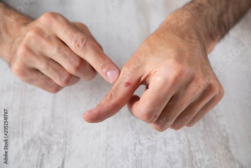 Photos Caucasian man showing callus on hand.