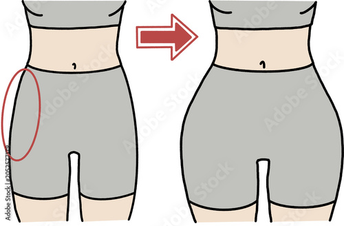 Tableau sur toile Woman body transformation before and after hip dips and pelvis widening exercise