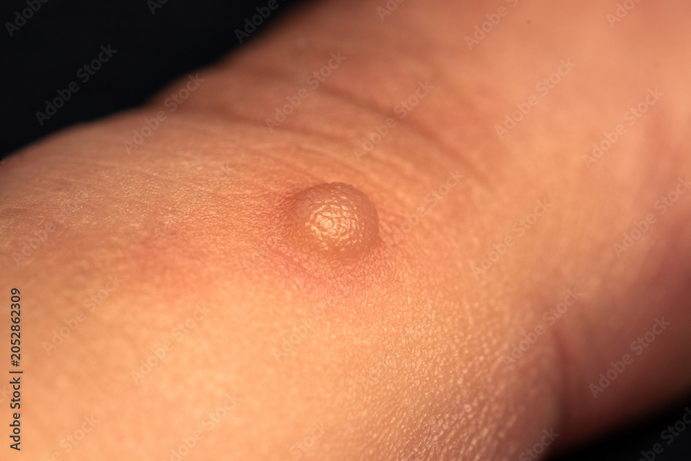Fototapeta premium Blister on a finger from a skin burn closeup