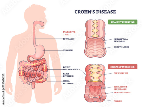 Фотография Crohn s disease diagram contrasts healthy and diseased intestine, highlighting p