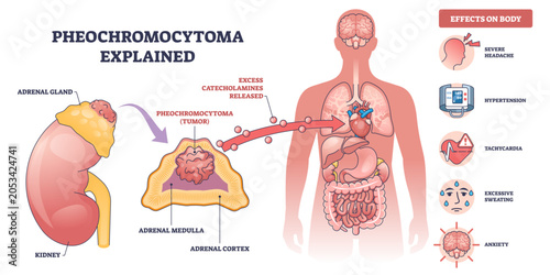 Obraz na płótnie Pheochromocytoma explained, adrenal gland tumor triggers excess catecholamines c