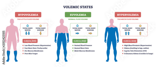 Fotografie Volemic States brief diagram contrasts body fluid balance, human silhouettes, ar