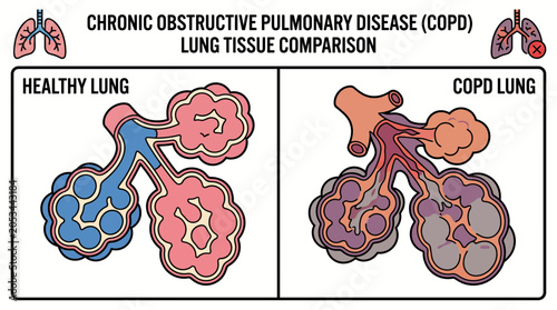 Fotografi Chronic Obstructive Pulmonary Disease Lung Tissue Comparison