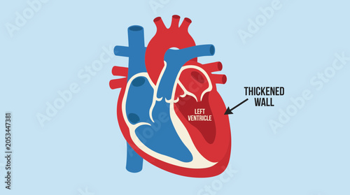 Foto Left Ventricular Hypertrophy Thickened Wall Illustration