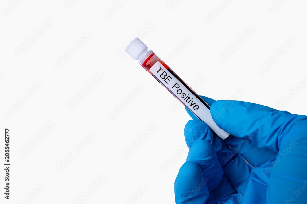 Obraz premium Tick borne Encephalitis Blood Sample Test Tube