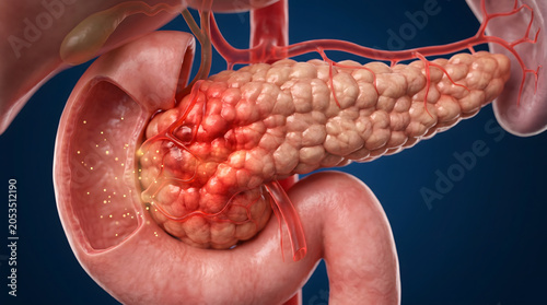 Detailed 3D medical illustration showing a cancerous tumor on the head of a human pancreas with inflammation near the duodenum anatomy.