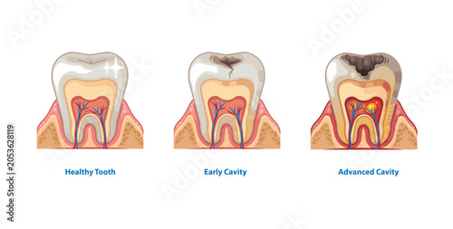 Tooth Decay Stages Progression Illustration