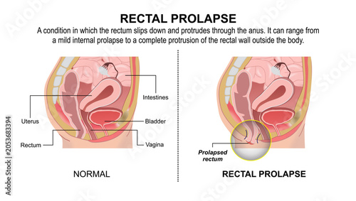 Bild auf Leinwand Rectal Prolapse, Rectum Flashcard Illustration