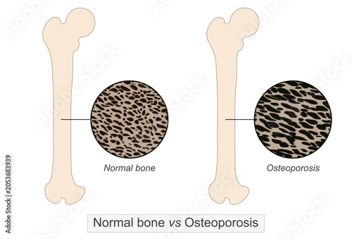 Medical vector illustration comparing healthy bone and osteoporosis affected bone.
