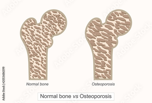 Healthy bone and osteoporotic bone comparison vector illustration for medical .