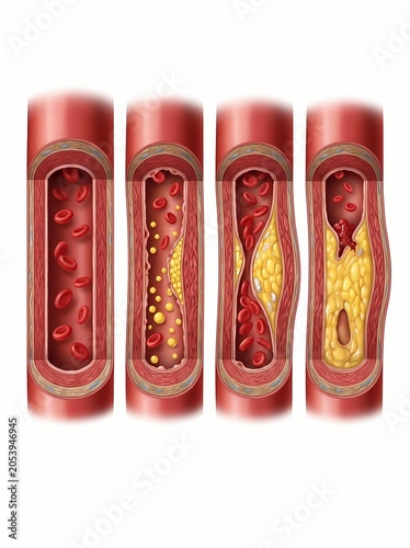 Medical illustration showing stages of atherosclerosis and plaque buildup in human blood arteries