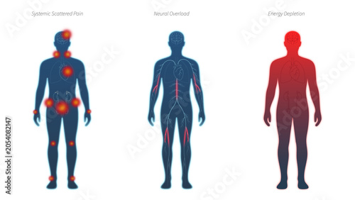 Vászonkép Chronic pain and mental stress infographics set
