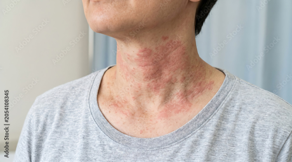 Naklejka premium Close up of red allergic rash and atopic dermatitis inflammation on woman neck skin texture for dermatological medical treatment clinical ad.