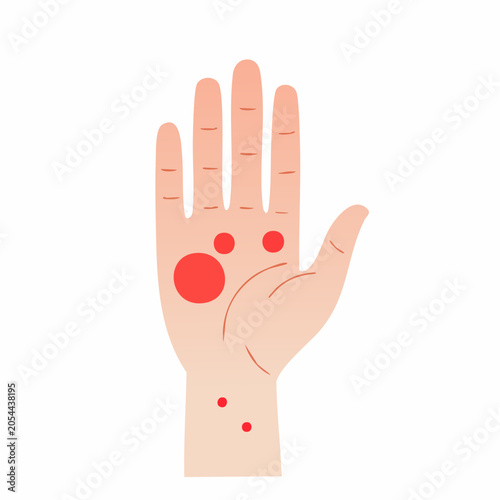Hand with Red Spots Indicating Rash or Allergic Reaction