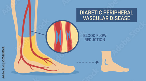 Bild auf Leinwand Diabetic Peripheral Vascular Disease Foot Blood Flow Reduction