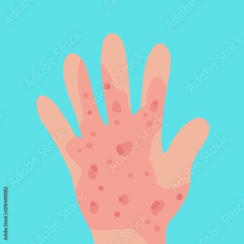 Φωτογραφία Itchy skin diseases in isolated background