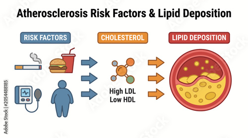 Fotografía Atherosclerosis Risk Factors Cholesterol Lipid Deposition Diagram