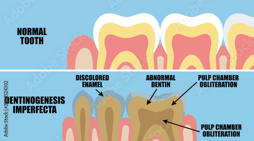Bild auf Leinwand Dentinogenesis Imperfecta Discolored Teeth Diagram