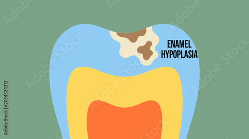 Photos Enamel Hypoplasia Developmental Defect Illustration