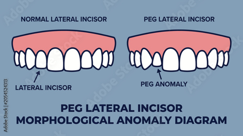 Foto Peg Lateral Incisor Morphological Anomaly Diagram