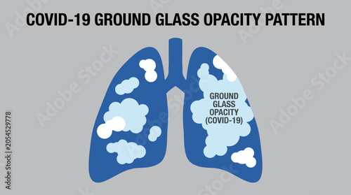 Cuadro en lienzo COVID-19 Ground Glass Opacity Pattern in Infected Lung Tissue