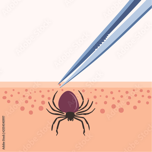 Tick Removal with Tweezers