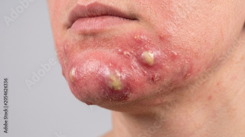 Macro Close Up of Severe Inflammatory Acne and Cystic Pustules on Human Chin and Jawline
