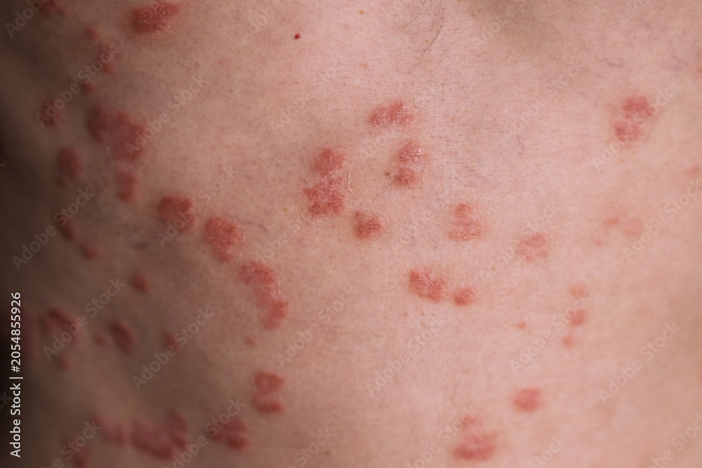 Fototapeta premium Close-up image of skin with psoriasis displaying red patches and scaling, highlighting the texture and condition of the affected area
